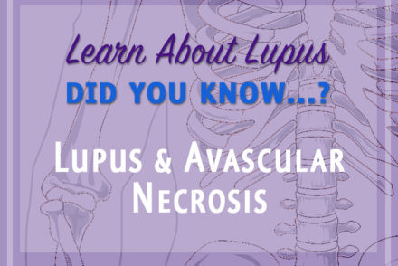 lupus hives avascular necrosis